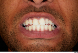 Aaron teeth 0001.jpg